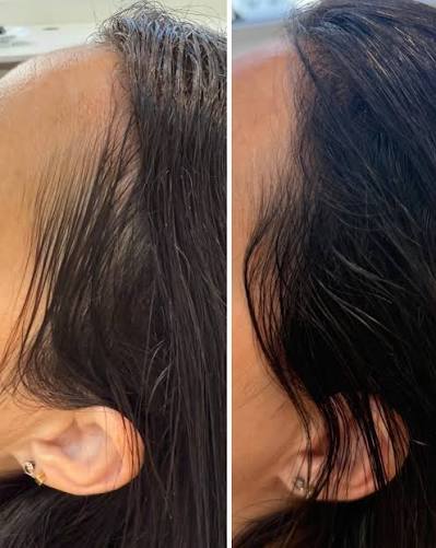 Comparação da linha frontal do cabelo antes e depois da reposição